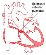 Estenosis Valvular Pulmonar
